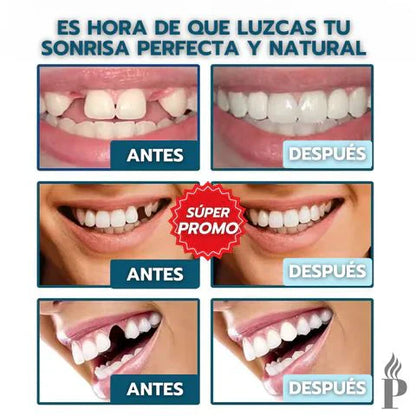 FlexiSmile Sonrisa Instantánea Carillas Dentales Adaptables🦷